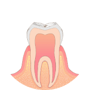 歯の表面にとても小さな虫歯ができます