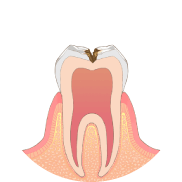 虫歯が神経に近くなり、冷たいものがしみます