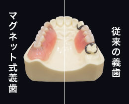 マグネット式義歯／従来の義歯