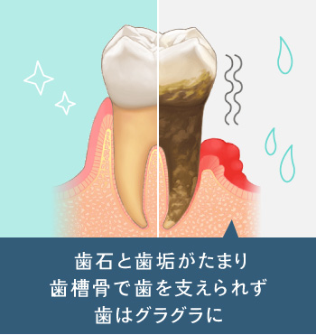 歯石と歯垢がたまり、歯槽骨で歯を支えられず歯はグラグラに